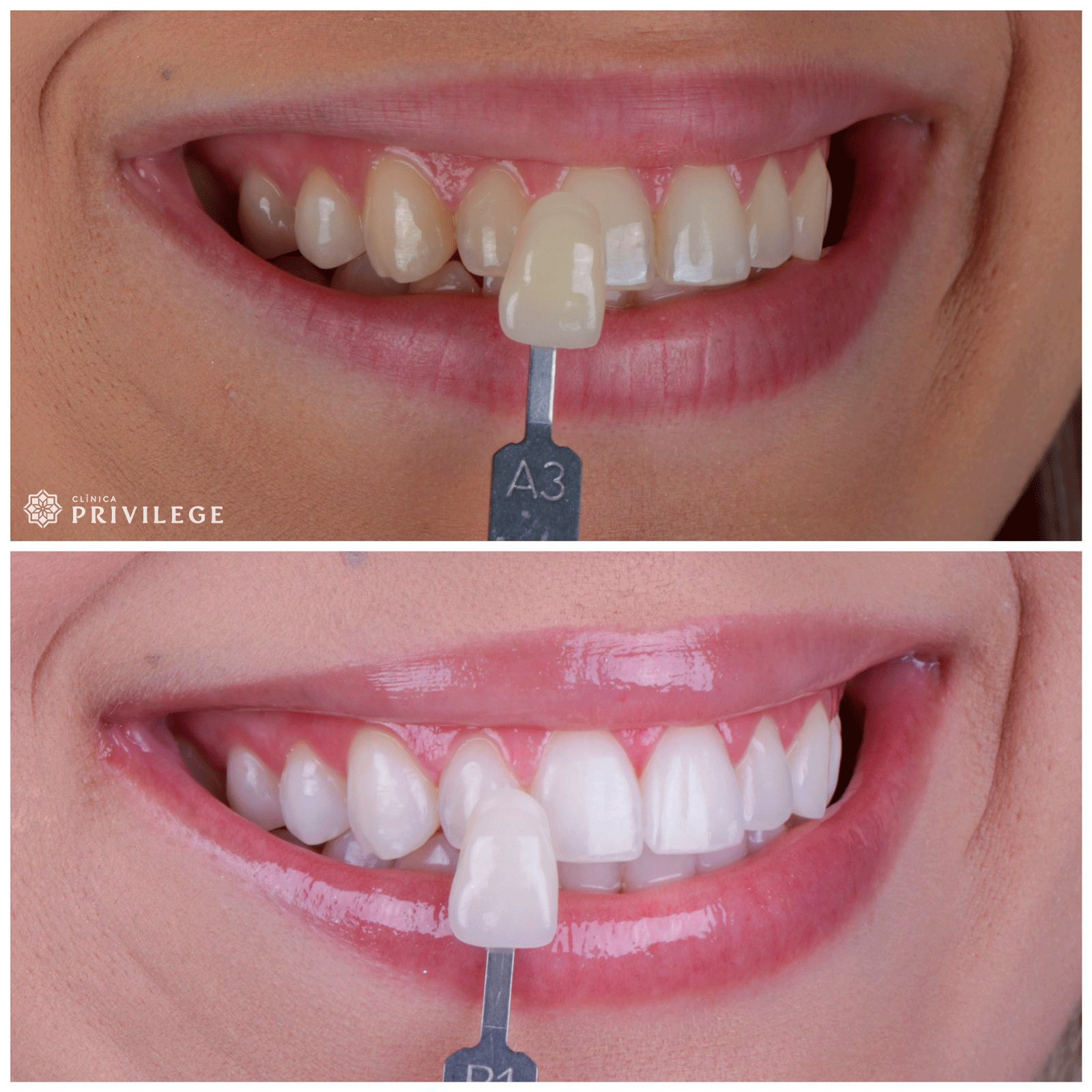 Before and after treatment