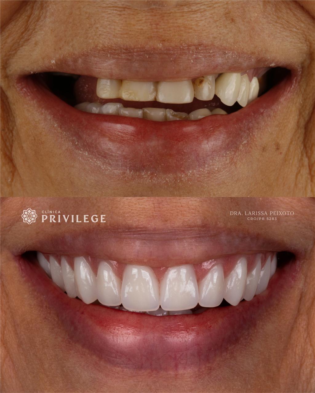 Before and after treatment
